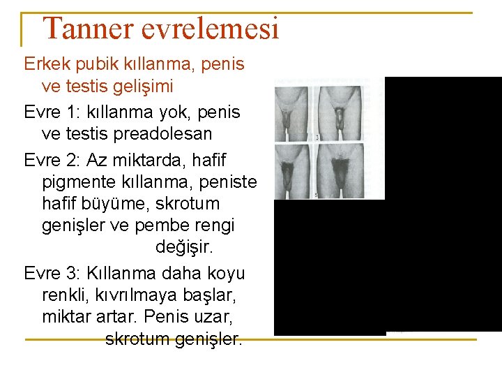 Tanner evrelemesi Erkek pubik kıllanma, penis ve testis gelişimi Evre 1: kıllanma yok, penis