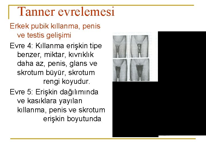 Tanner evrelemesi Erkek pubik kıllanma, penis ve testis gelişimi Evre 4: Kıllanma erişkin tipe