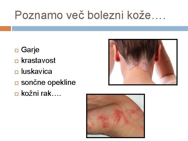 Poznamo več bolezni kože…. Garje krastavost luskavica sončne opekline kožni rak…. 