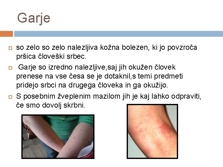 Garje so zelo nalezljiva kožna bolezen, ki jo povzroča pršica človeški srbec. Garje so