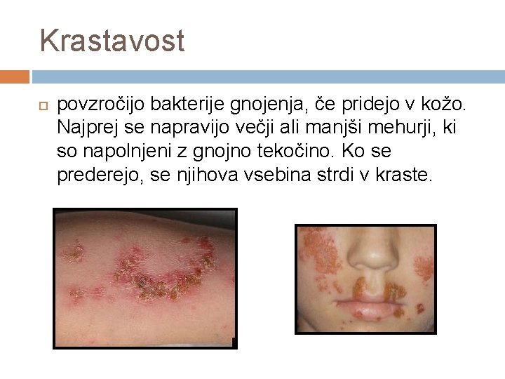 Krastavost povzročijo bakterije gnojenja, če pridejo v kožo. Najprej se napravijo večji ali manjši