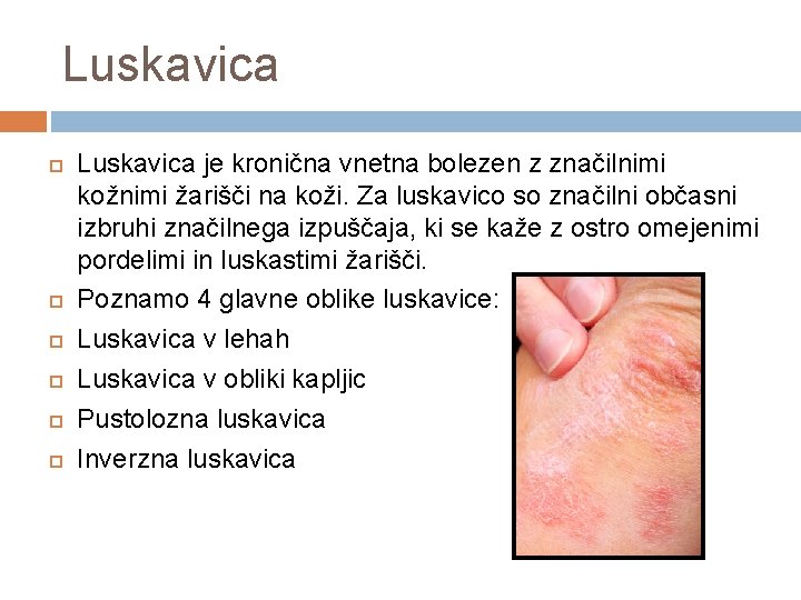 Luskavica Luskavica je kronična vnetna bolezen z značilnimi kožnimi žarišči na koži. Za luskavico
