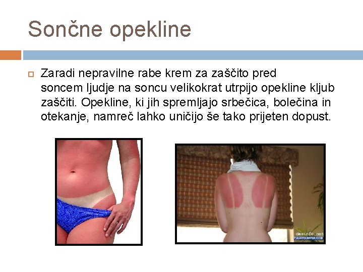 Sončne opekline Zaradi nepravilne rabe krem za zaščito pred soncem ljudje na soncu velikokrat