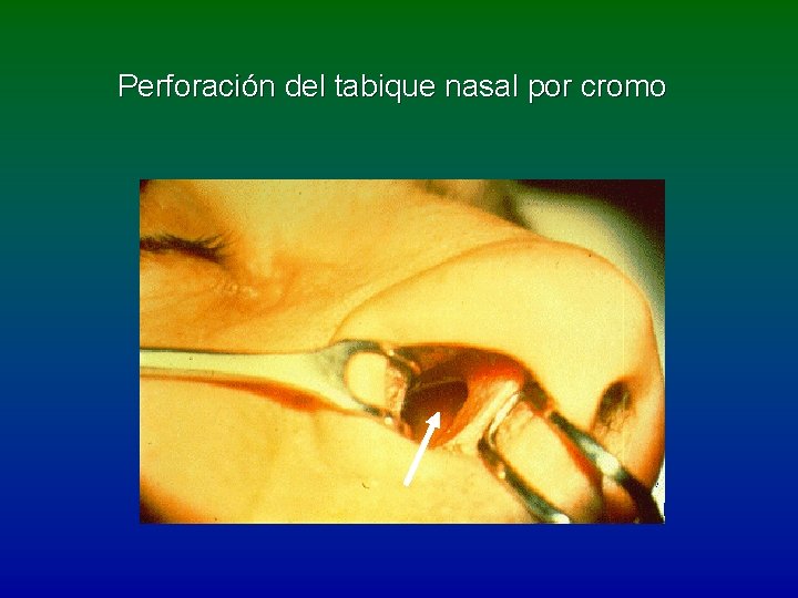 Perforación del tabique nasal por cromo 