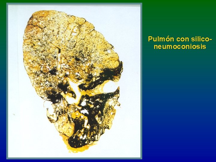 Pulmón con siliconeumoconiosis 