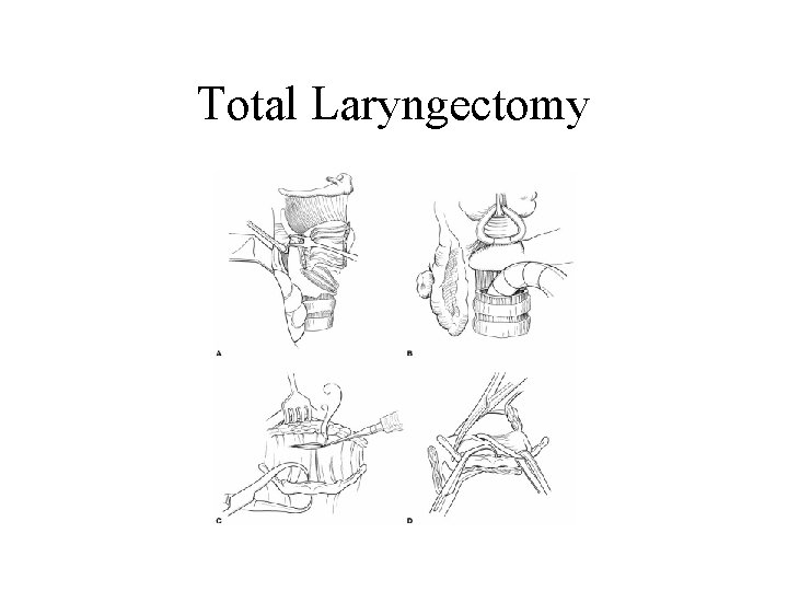Total Laryngectomy 