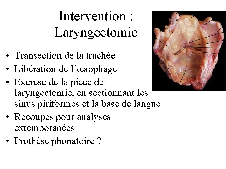 Intervention : Laryngectomie • Transection de la trachée • Libération de l’œsophage • Exerèse