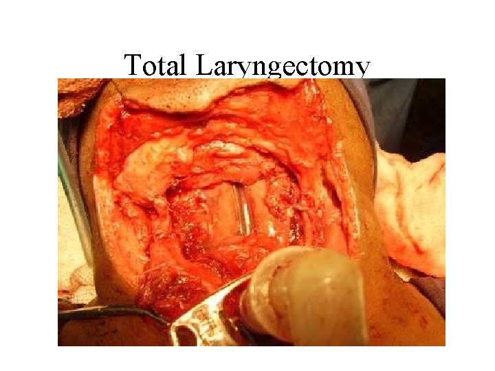 Total Laryngectomy 
