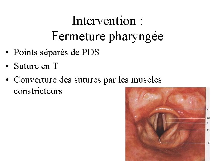 Intervention : Fermeture pharyngée • Points séparés de PDS • Suture en T •