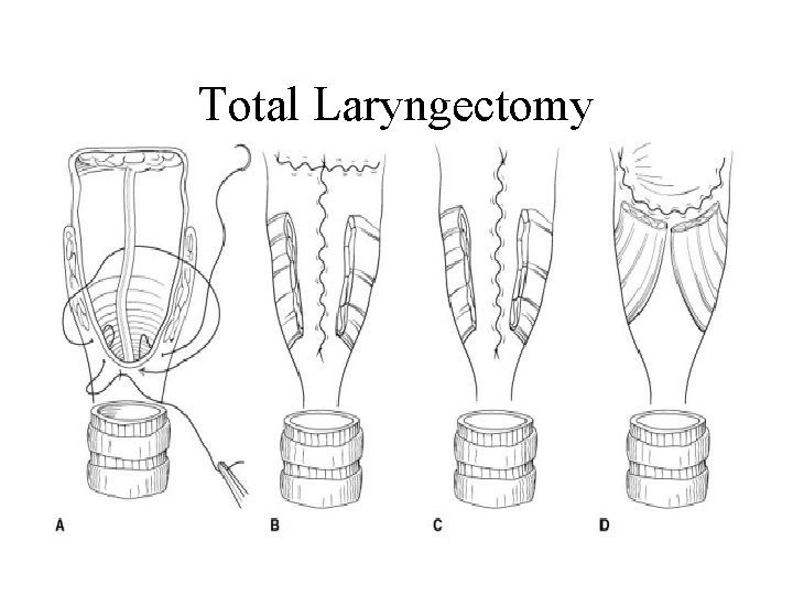 Total Laryngectomy 