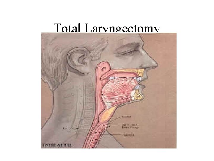 Total Laryngectomy 