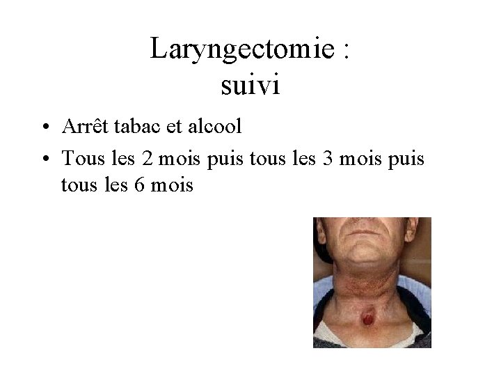 Laryngectomie : suivi • Arrêt tabac et alcool • Tous les 2 mois puis