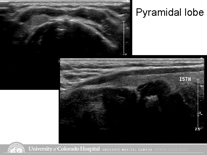 Pyramidal lobe Pyramidal lobe
