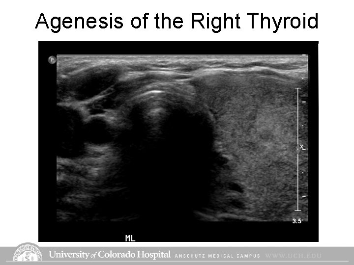 Agenesis of the Right Thyroid Agenesis of the Right Thyroid