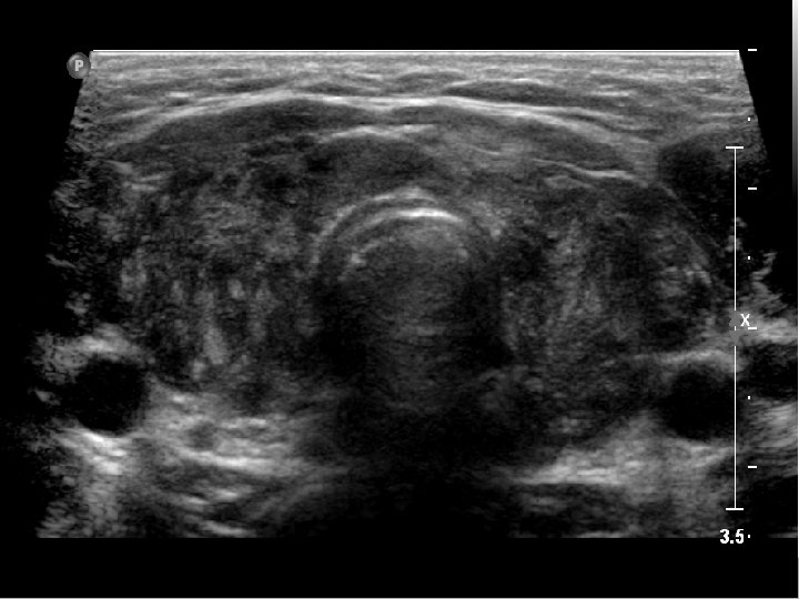 Hashimoto’s Thyroiditis (early) Hashimoto’s Thyroiditis (early)