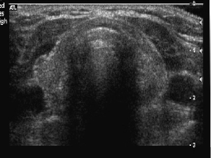 Hashimoto’s Thyroiditis (burn out) Hashimoto’s Thyroiditis (burn out)