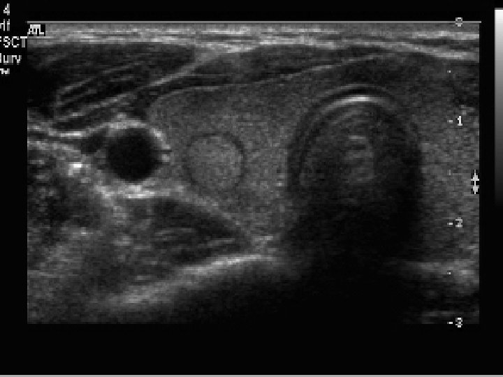 Adenoma Adenoma