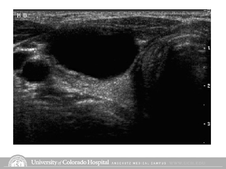 Cysts Cysts