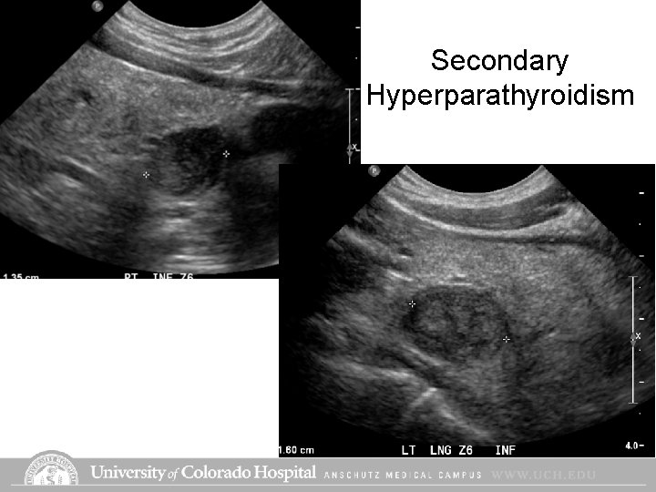 Secondary Hyperparathyroidism Secondary Hyperparathyroidism