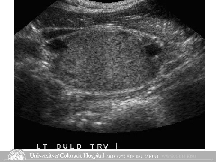 Carotid Body Tumor Carotid Body Tumor