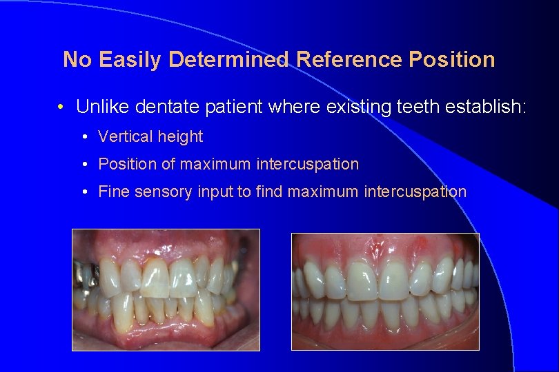No Easily Determined Reference Position • Unlike dentate patient where existing teeth establish: •