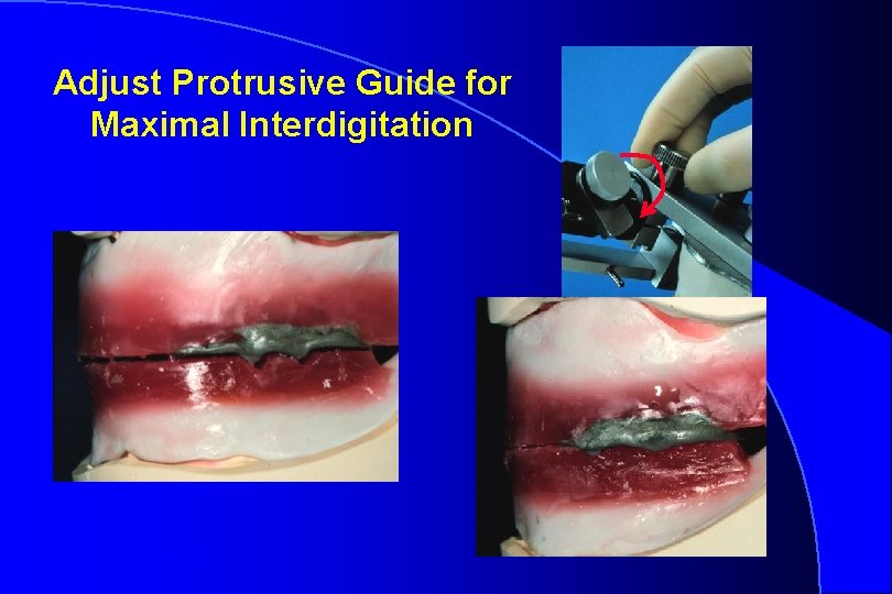 Adjust Protrusive Guide for Maximal Interdigitation Robert W. Loney 