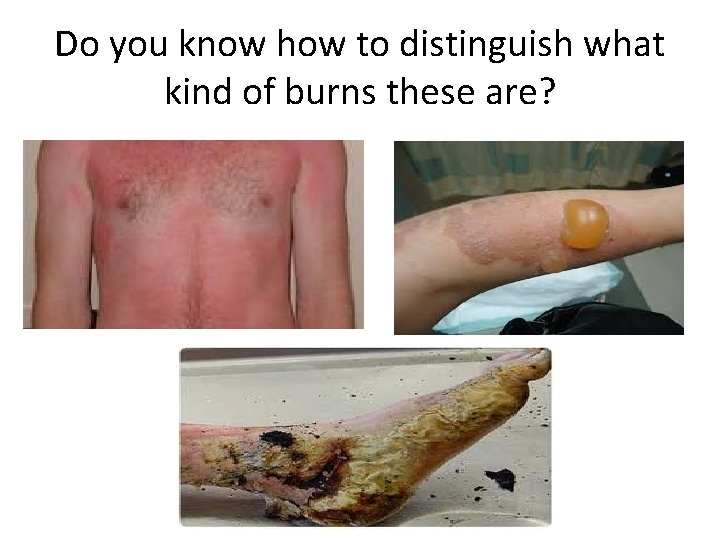 Do you know how to distinguish what kind of burns these are? 
