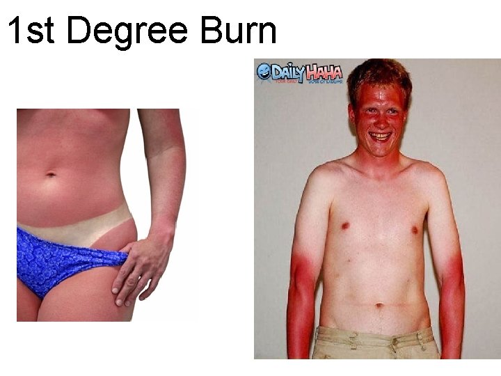 1 st Degree Burn 