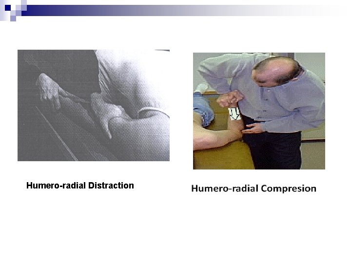 Humero radial Distraction 