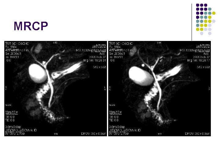 MRCP 