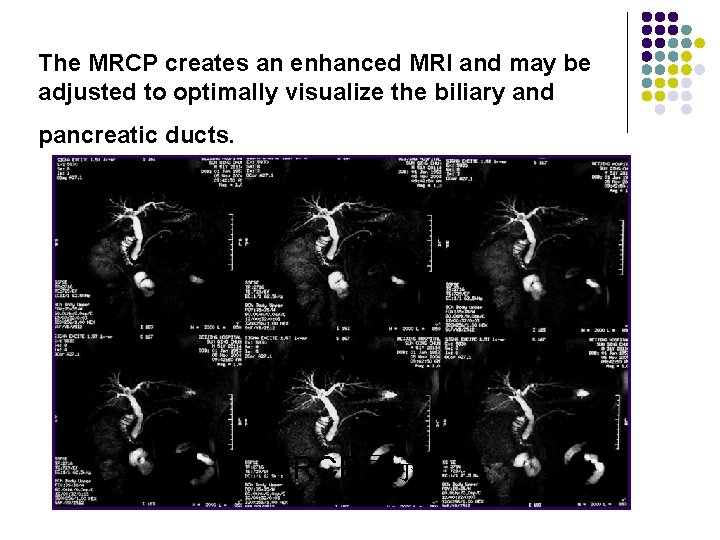 The MRCP creates an enhanced MRI and may be adjusted to optimally visualize the