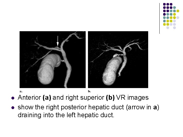 l l Anterior (a) and right superior (b) VR images show the right posterior