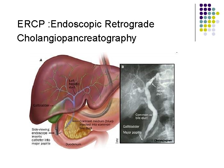 ERCP : Endoscopic Retrograde Cholangiopancreatography 