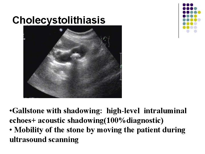 Cholecystolithiasis • Gallstone with shadowing: high-level intraluminal echoes+ acoustic shadowing(100%diagnostic) • Mobility of the