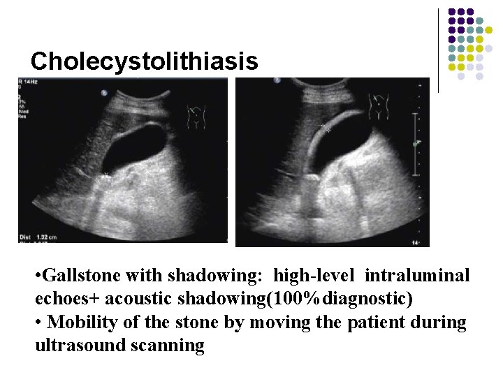 Cholecystolithiasis • Gallstone with shadowing: high-level intraluminal echoes+ acoustic shadowing(100%diagnostic) • Mobility of the