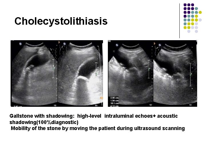 Cholecystolithiasis Gallstone with shadowing: high-level intraluminal echoes+ acoustic shadowing(100%diagnostic) Mobility of the stone by