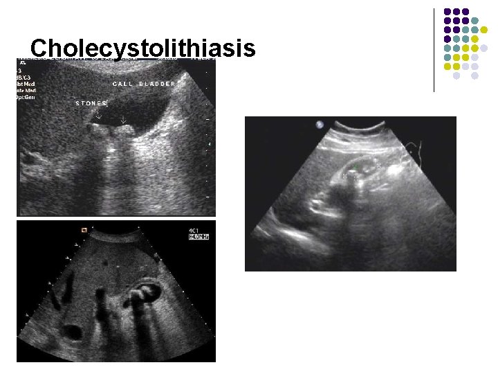 Cholecystolithiasis 