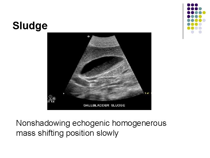 Sludge Nonshadowing echogenic homogenerous mass shifting position slowly 