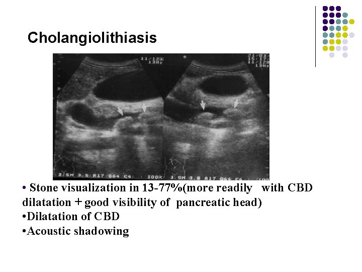 Cholangiolithiasis • Stone visualization in 13 -77%(more readily with CBD dilatation + good visibility