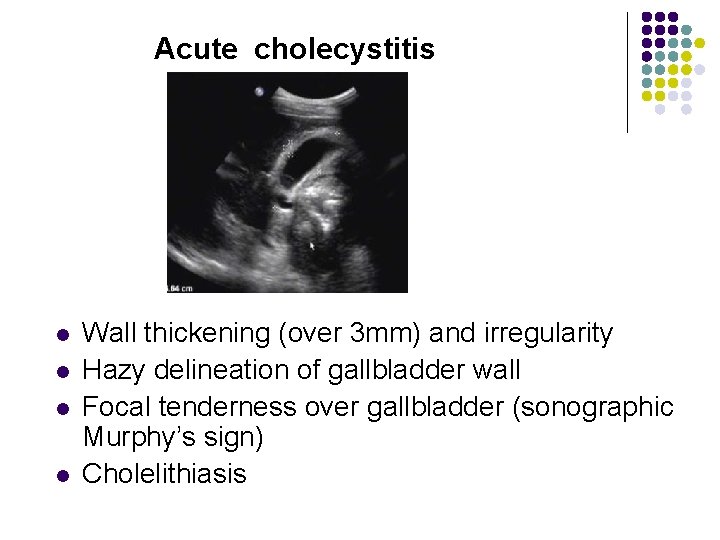 Acute cholecystitis l l Wall thickening (over 3 mm) and irregularity Hazy delineation of