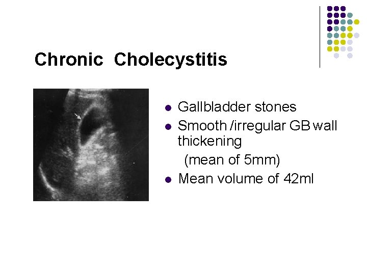 Chronic Cholecystitis l l l Gallbladder stones Smooth /irregular GB wall thickening (mean of