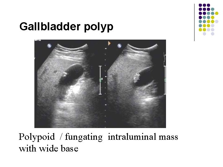 Gallbladder polyp Polypoid / fungating intraluminal mass with wide base 