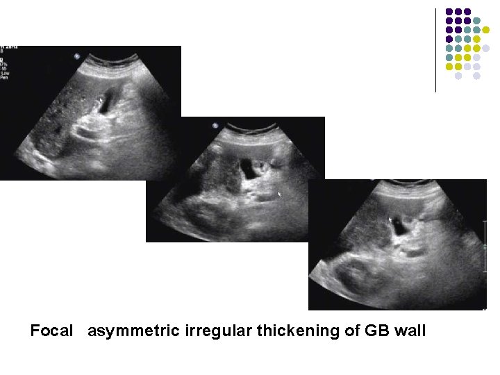 Focal asymmetric irregular thickening of GB wall 