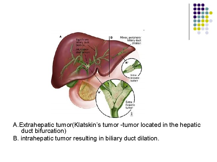 A. Extrahepatic tumor(Klatskin’s tumor -tumor located in the hepatic duct bifurcation) B. intrahepatic tumor