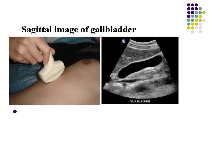 Sagittal image of gallbladder l 
