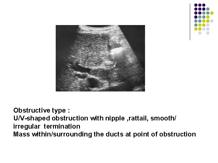Obstructive type : U/V-shaped obstruction with nipple , rattail, smooth/ irregular termination Mass within/surrounding