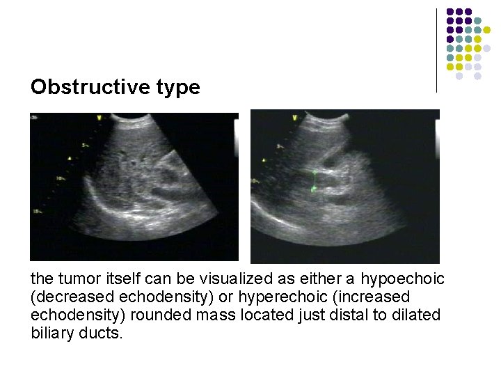 Obstructive type the tumor itself can be visualized as either a hypoechoic (decreased echodensity)