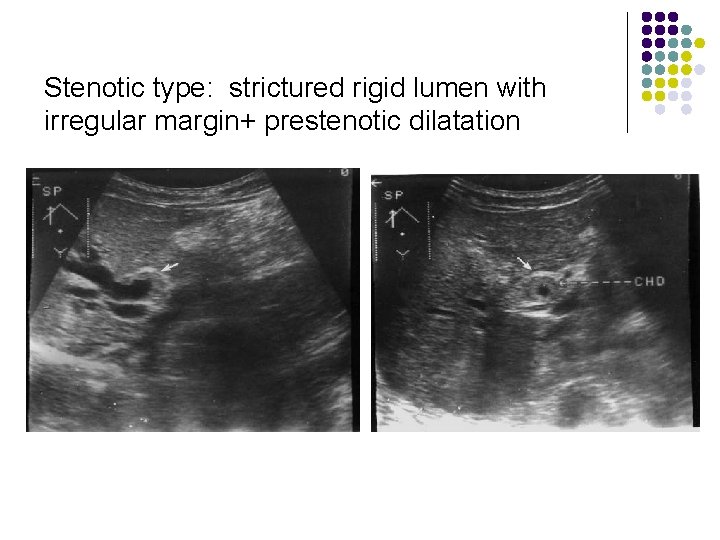 Stenotic type: strictured rigid lumen with irregular margin+ prestenotic dilatation 