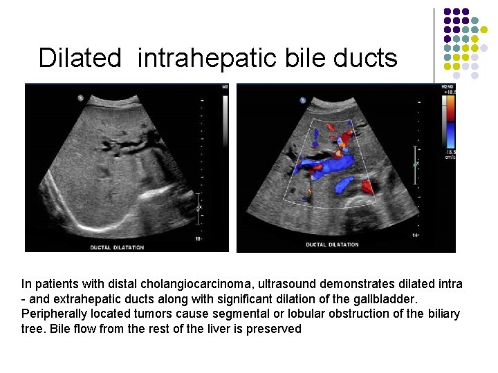 Dilated intrahepatic bile ducts In patients with distal cholangiocarcinoma, ultrasound demonstrates dilated intra -