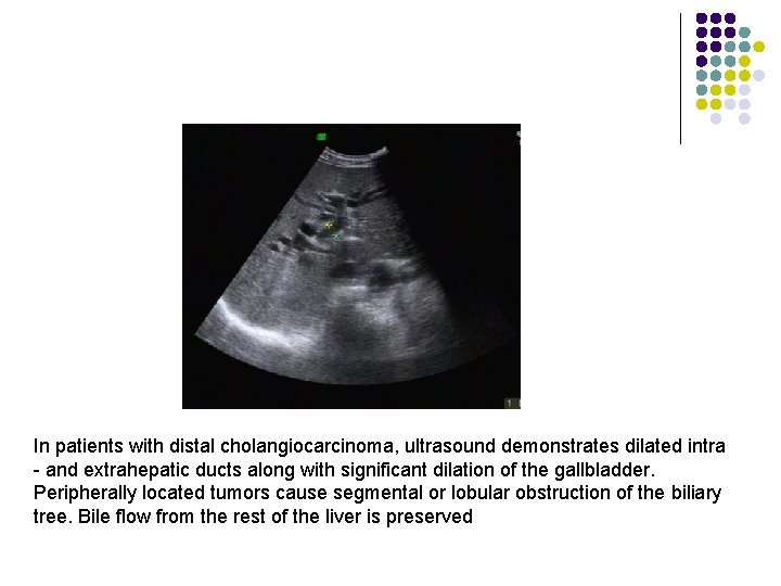 In patients with distal cholangiocarcinoma, ultrasound demonstrates dilated intra - and extrahepatic ducts along